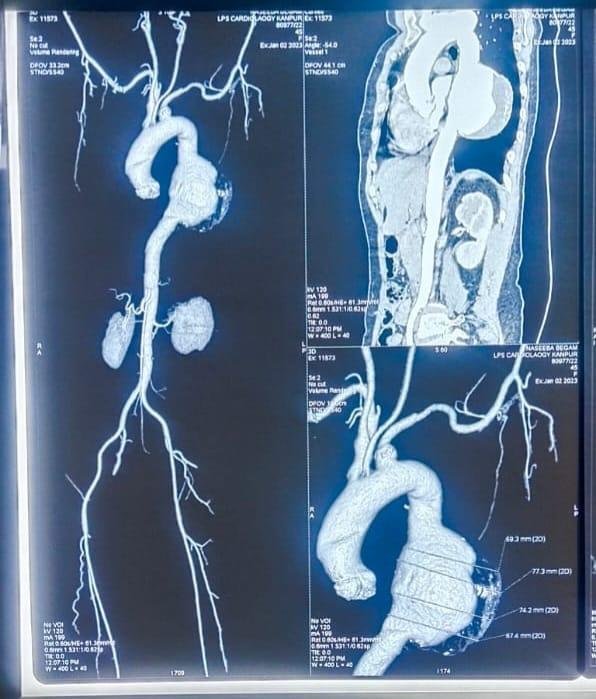 कानपुर15जनवरी2023*एन्डोवैस्कुलर विधि द्वारा सफल उपचार