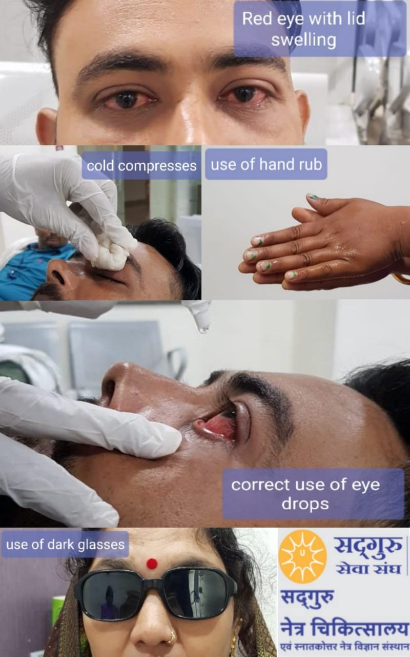 चित्रकूट28जुलाई2023*आई फ्लू क्या है? घबराएं नही जाने कारण,लक्षण और बचाव