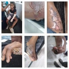 कानपुर23सितम्बर23*(बिल्हौर) 11 हजार बोल्टेज टूटे पड़े बिजली के तार की चपेट में आई बालिका झुलसी