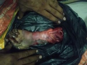 कानपुर26सितम्बर23*विद्युत करेंट से हताहत छात्रा का आज डॉक्टरों को छात्रा का हाँथ काटना पड़ा।