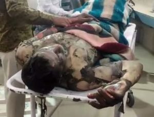 शामली06नवम्बर23*शादी से मना करने पर युवक ने खुद को किया आग के हवाले! 80% जला मेरठ रेफर*