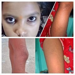 हरदोई07नवम्बर23*हरदोई में बच्ची के शरीर पर उभर रहे राम और राधे नाम का शब्द,डॉक्टर भी हैरान*