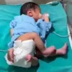 मेरठ10नवम्बर23*मुजफ्फरनगर में जन्मे चार हाथ और चार पैर वाले बच्चे का मेरठ मेडिकल कालेज में इलाज मेरठ10नवम्बर23*मुजफ्फरनगर में जन्मे चार हाथ और चार पैर वाले बच्चे का मेरठ मेडिकल कालेज में इलाज