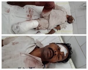 अनूपपुर 08 अक्टूबर 24*ट्रेन से गिरने पर युवक का कटा पैर, विशेषज्ञ डॉक्टरो ने किया ऑपरेशन