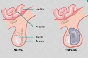 पूर्णिया बिहार20दिसंबर24*हाइड्रोसील फाइलेरिया ग्रसित मरीजों के ऑपरेशन सुविधा उपलब्ध कराने का दिया गया है निर्देश।