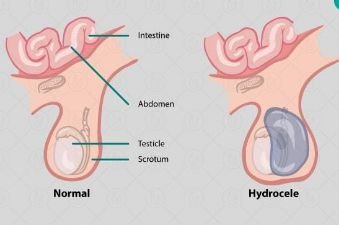 पूर्णिया बिहार20दिसंबर24*हाइड्रोसील फाइलेरिया ग्रसित मरीजों के ऑपरेशन सुविधा उपलब्ध कराने का दिया गया है निर्देश। पूर्णिया बिहार20दिसंबर24*हाइड्रोसील फाइलेरिया ग्रसित मरीजों के ऑपरेशन सुविधा उपलब्ध कराने का दिया गया है निर्देश।