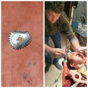 पूर्णिया बिहार 15 जनवरी25* GMCH के डॉक्टर ने बचाई 4 वर्षीय बच्चे की जान