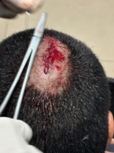 पूर्णिया बिहार 23 फरवरी 25 विद्यार्थी विनीत कुमार पर जानलेवा हमला,