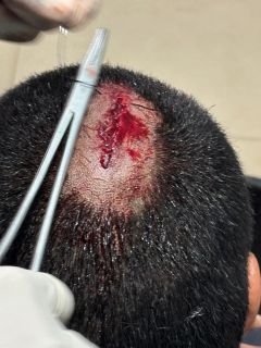 पूर्णिया बिहार 23 फरवरी 25 विद्यार्थी विनीत कुमार पर जानलेवा हमला,