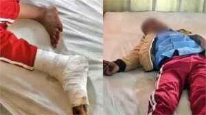 हरदोई24फरवरी25*शिक्षक की क्रूरता: तीसरी कक्षा के छात्र को ''मुर्गा'' बनाकर पीठ पर बैठ गया टीचर, मासूम का पैर हुआ फ्रैक्चर*