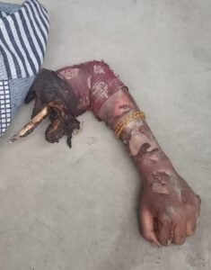 पूर्णिया बिहार 15 अप्रैल 25* लापरवाही से एक किशोरी अपना हाथ गंवा बैठी।