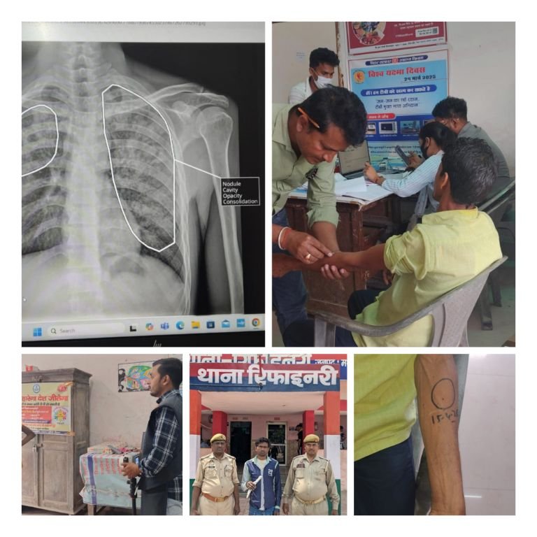 पूर्णिया बिहार 16 अप्रैल25* संभावित टीबी ग्रसित मरीजों की पहचान के लिए जिला यक्ष्मा केंद्र में जांच कैम्प