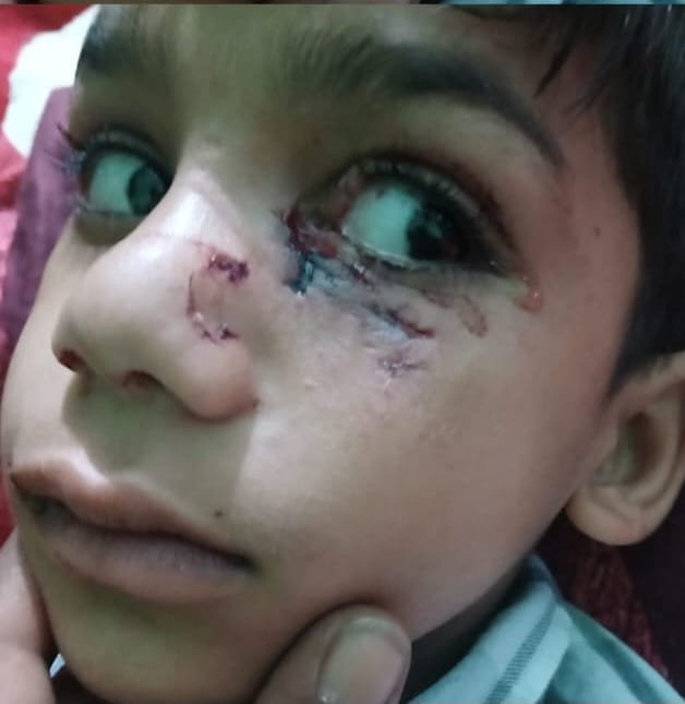 *सहारनपुर04जून25*अंबेहटा में 6 वर्षीय बालक को कुत्तों ने काटकर ज़ख़्मी किया हालत गंभीर।*