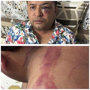 लखनऊ6जून25*राजधानी के चिनहट में अधिवक्ता अभिषेक गुप्ता पर देर रात कातिलाना हमला।