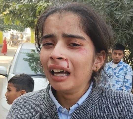आगरा 6दिसम्बर 25*दो चोटी न बनाने पर छात्रा को शिक्षकों ने बेरहमी से पीटा।