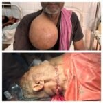 पूर्णिया बिहार18अप्रैल26* इंसानियत की जीत : 30 साल का दर्द खत्म, GMCH पूर्णिया में गरीब मजदूर का फ्री ऑपरेशन*