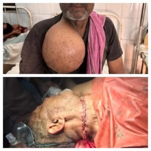 पूर्णिया बिहार18अप्रैल26* इंसानियत की जीत : 30 साल का दर्द खत्म, GMCH पूर्णिया में गरीब मजदूर का फ्री ऑपरेशन*